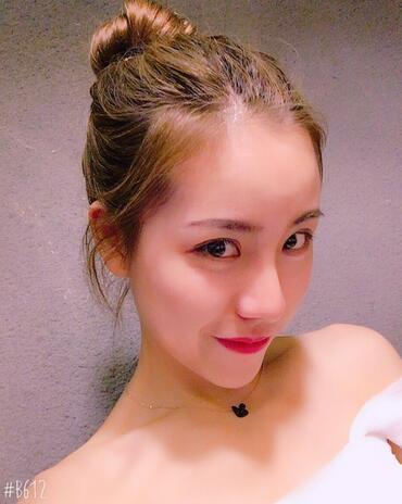 北京藝星王英勇隆鼻案例 隆鼻整形三個(gè)月