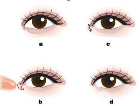 開(kāi)內(nèi)眼角的危害有哪些？