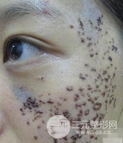 南寧緩解的太田痣真實(shí)案例,前后果對比圖