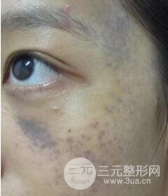 南寧緩解的太田痣真實(shí)案例,前后果對比圖