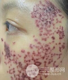 南寧緩解的太田痣真實(shí)案例,前后果對比圖