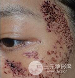 做了三次激光去太田痣，后來的果已經(jīng)是我較為滿意的了。