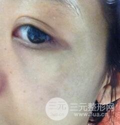 做了三次激光去太田痣，后來的果已經(jīng)是我較為滿意的了。