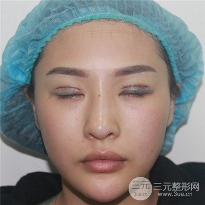 溫州友好醫(yī)院羅吉華眼部整形失敗修復真人案例分享