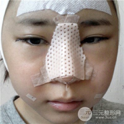 四川美萊牛永敢隆鼻整形三個(gè)月果照片分享~