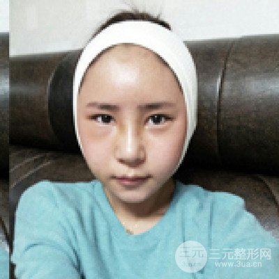 四川美萊牛永敢隆鼻整形三個(gè)月果照片分享~