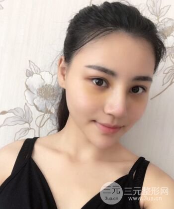 在漢中韓美做了隆鼻整形一個月，恢復越來越自然了