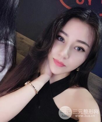 在漢中韓美做了隆鼻整形一個月，恢復越來越自然了