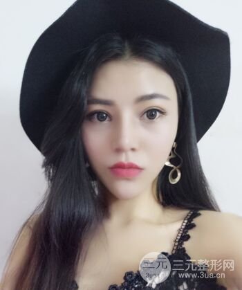 在漢中韓美做了隆鼻整形一個月，恢復越來越自然了