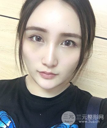 面部埋埋蛋白線.提升前后對(duì)比照片，皮膚緊致了不少