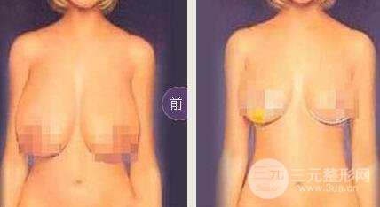 巨大乳房縮小多少錢(qián)？成好嗎?巨大乳房縮小對(duì)比圖