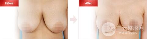 巨大乳房縮小多少錢(qián)？成好嗎?巨大乳房縮小對(duì)比圖
