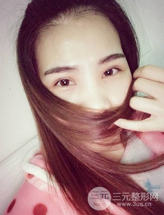 漢中韓美切開(kāi)雙眼皮開(kāi)眼角恢復(fù)對(duì)比照片