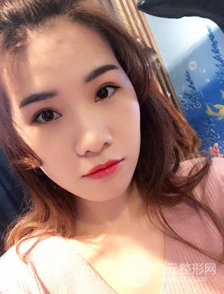 漢中韓美切開(kāi)雙眼皮開(kāi)眼角恢復(fù)對(duì)比照片