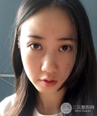 埋線雙眼皮真人案例和十天恢復圖片日記