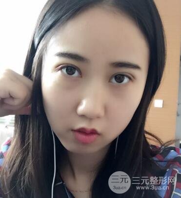 埋線雙眼皮真人案例和十天恢復圖片日記