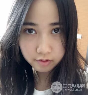 埋線雙眼皮真人案例和十天恢復圖片日記