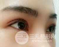 切開雙眼皮恢復過程對比圖和真人案例 切開雙眼皮價格4600元