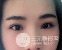 切開雙眼皮恢復過程對比圖和真人案例 切開雙眼皮價格4600元