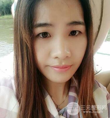 切開(kāi)雙眼皮恢復(fù)過(guò)程對(duì)比圖和真人案例 切開(kāi)雙眼皮價(jià)格4600元