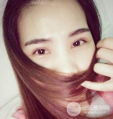 切開(kāi)雙眼皮恢復(fù)過(guò)程對(duì)比圖和真人案例 切開(kāi)雙眼皮價(jià)格4600元