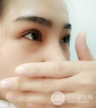 切開(kāi)雙眼皮恢復(fù)過(guò)程對(duì)比圖和真人案例 切開(kāi)雙眼皮價(jià)格4600元