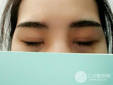 切開(kāi)雙眼皮恢復(fù)過(guò)程對(duì)比圖和真人案例 切開(kāi)雙眼皮價(jià)格4600元