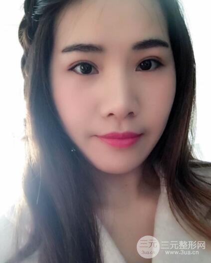 切開(kāi)雙眼皮恢復(fù)過(guò)程對(duì)比圖和真人案例 切開(kāi)雙眼皮價(jià)格4600元