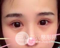 割雙眼皮六個月恢復過程圖片和真實案例