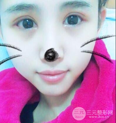 割雙眼皮六個月恢復(fù)過程圖片和真實案例