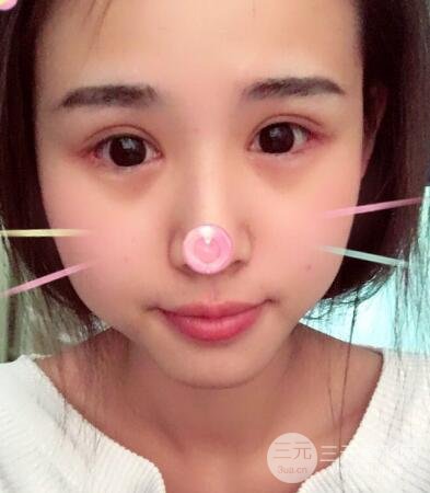 割雙眼皮六個月恢復(fù)過程圖片和真實案例