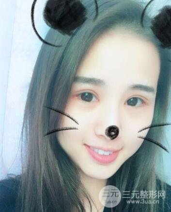 割雙眼皮六個月恢復(fù)過程圖片和真實案例