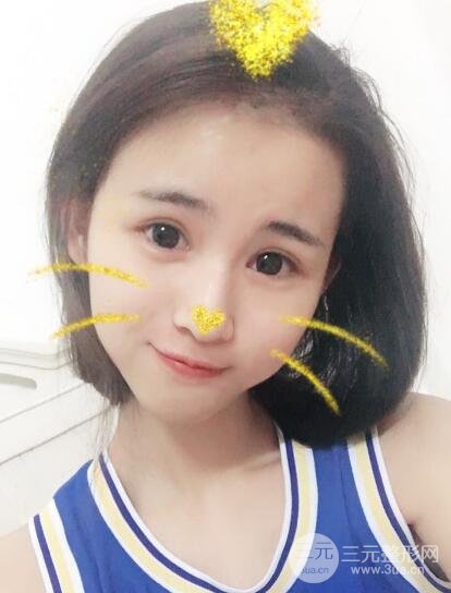 割雙眼皮六個月恢復(fù)過程圖片和真實案例