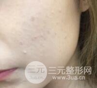 水光補(bǔ)水嫩膚果圖前后對(duì)比和恢復(fù)過(guò)程真實(shí)案例分享