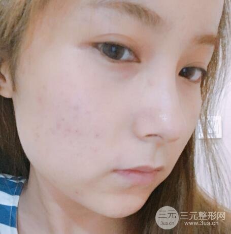 水光補(bǔ)水嫩膚果圖前后對比和恢復(fù)過程真實(shí)案例分享