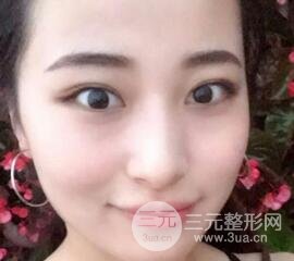 痘坑痘疤要怎么修復(fù)？果酸換膚后臉果圖和真實(shí)案例分享