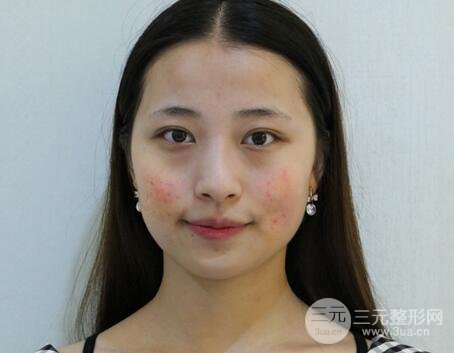 痘坑痘疤要怎么修復?果酸換膚后臉果圖和真實案例分享
