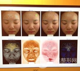 痘坑痘疤要怎么修復?果酸換膚后臉果圖和真實案例分享