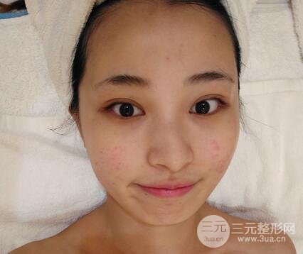 痘坑痘疤要怎么修復?果酸換膚后臉果圖和真實案例分享
