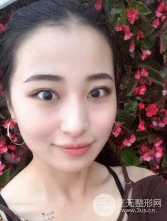 痘坑痘疤要怎么修復?果酸換膚后臉果圖和真實案例分享