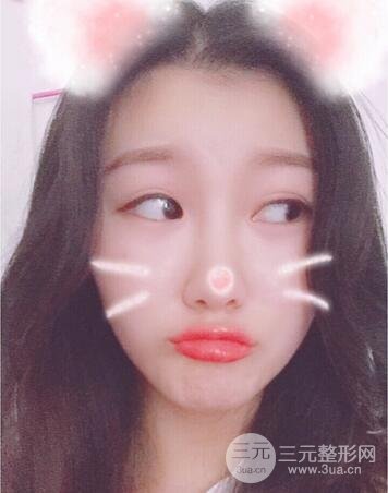 長沙鵬愛隆鼻整形果展示 恢復(fù)過程圖