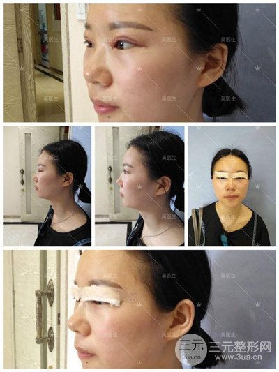 武漢卓美吳秀英雙眼皮+開(kāi)眼角一個(gè)月恢復(fù)對(duì)比照片分享~