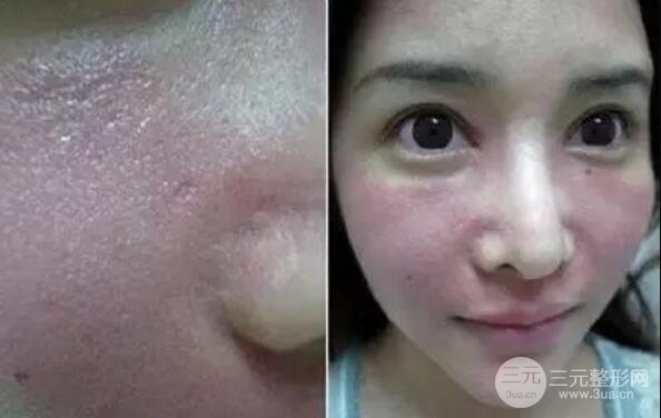 我做了光子嫩膚幾天起而且價(jià)格便宜前后對比照片案例