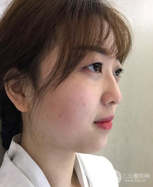 腫泡眼單眼皮變雙眼皮真實(shí)切開(kāi)雙眼皮案例和對(duì)比圖