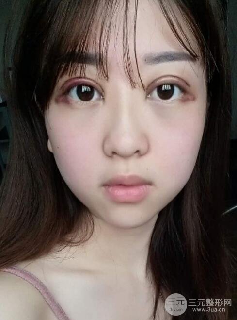 腫泡眼單眼皮變雙眼皮真實(shí)切開(kāi)雙眼皮案例和對(duì)比圖