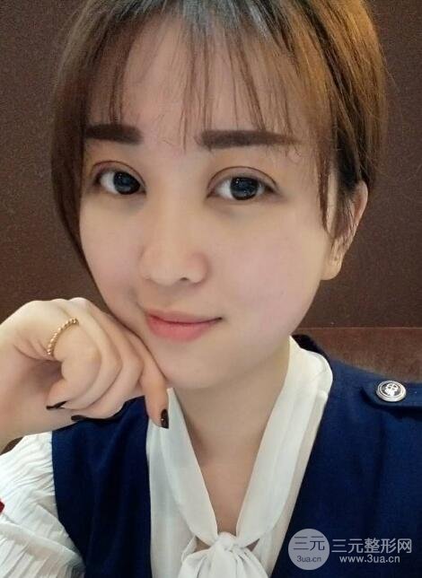 腫泡眼單眼皮變雙眼皮真實(shí)切開(kāi)雙眼皮案例和對(duì)比圖