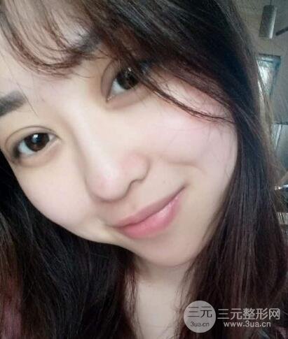 腫泡眼單眼皮變雙眼皮真實(shí)切開(kāi)雙眼皮案例和對(duì)比圖