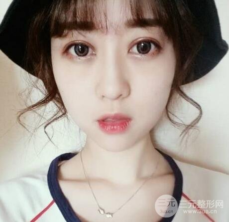 腫泡眼單眼皮變雙眼皮真實(shí)切開(kāi)雙眼皮案例和對(duì)比圖