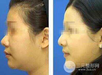 面部吸脂大概要多少錢？面部吸脂減肥價(jià)格表和前后果圖片