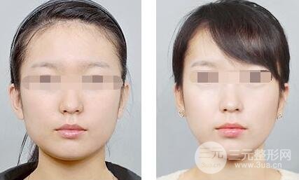面部吸脂大概要多少錢？面部吸脂減肥價(jià)格表和前后果圖片